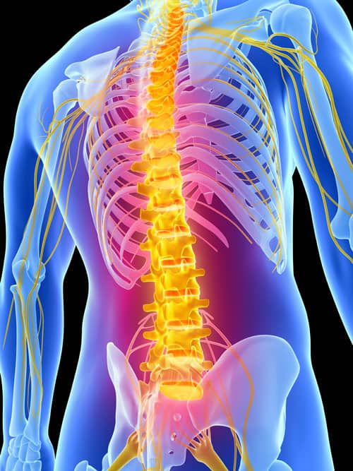CAUSE OF SPINAL STENOSIS