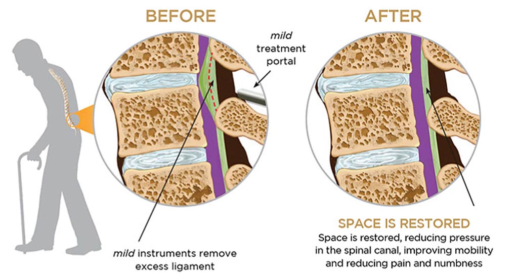 spinal stenosis symptoms