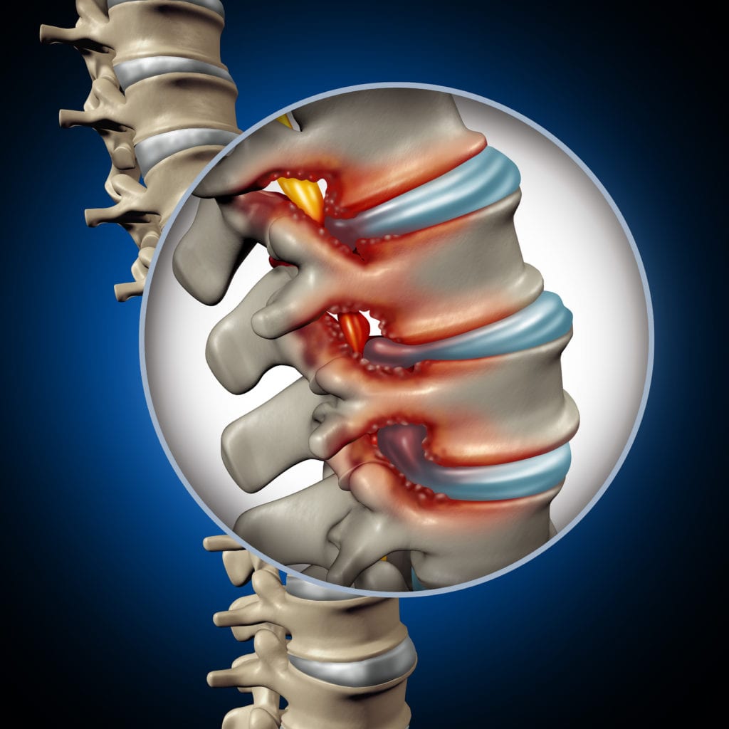 Types of Spinal Stenosis