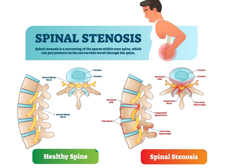 spinal stenosis treatment