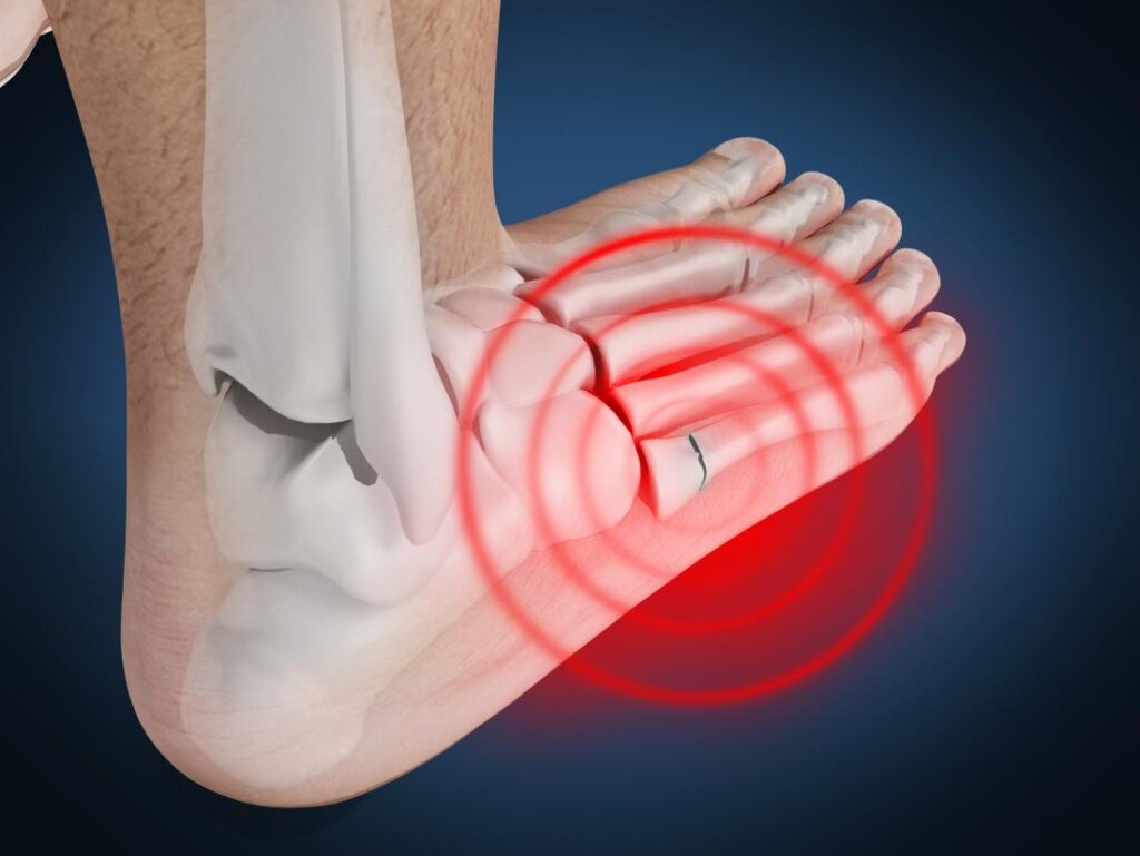 SYMPTOMS OF MARCH FRACTURE