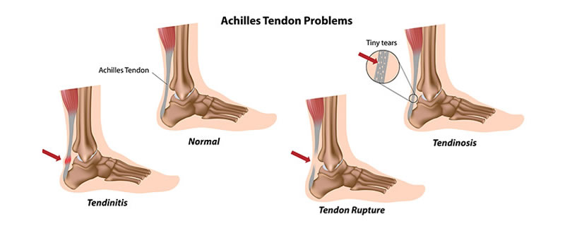 HOW COVID-19 IS AFFECTING FOOT?