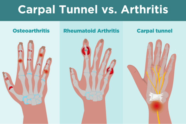 Thumb Joint Pain - Cause and Diagnose