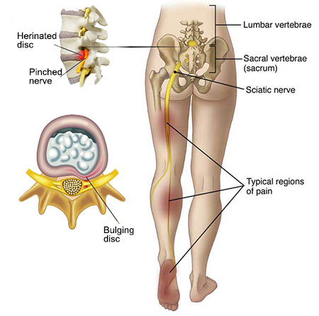 WHAT IS SCIATICA?