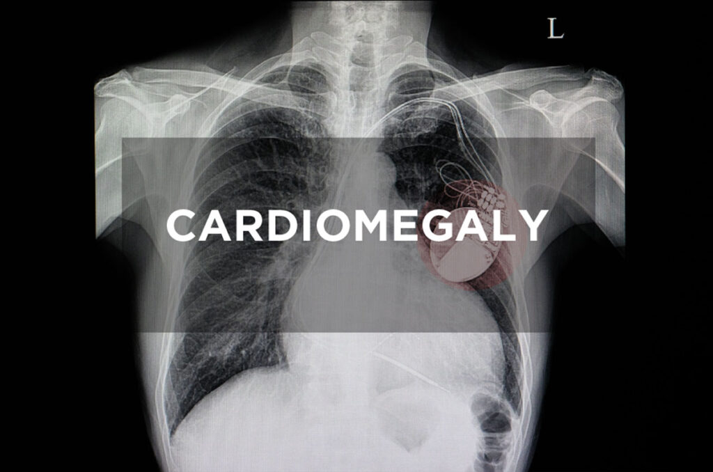 enlarged heart symptoms