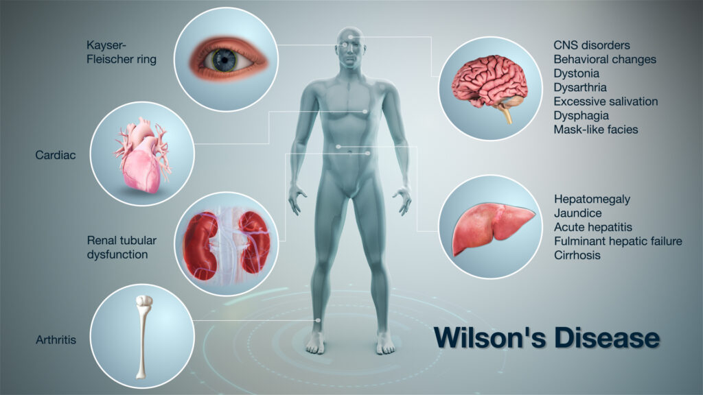 WHAT IS WILSON'S DISEASE?