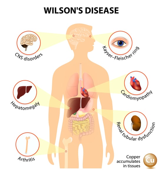 WILSON'S DISEASE SYMPTOMS