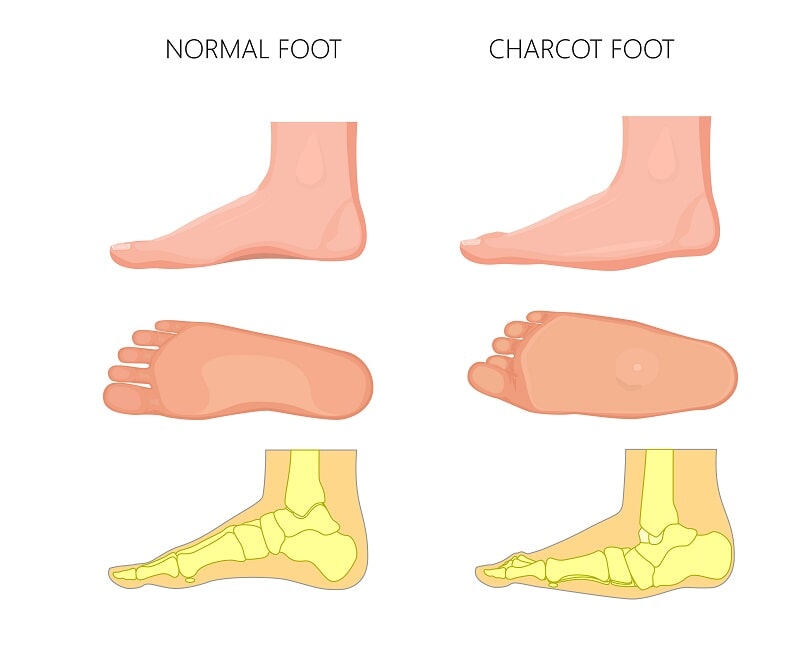 Normal Foot and Charcot Foot 