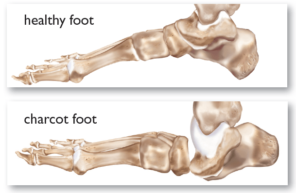 Healthy Foot Compare With Charcot Foot 