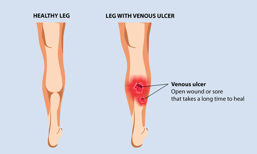 SYMPTOMS OF FOOT AND LEG ULCERS