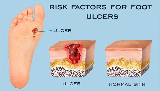 Risk Factors of Foot Ulcers