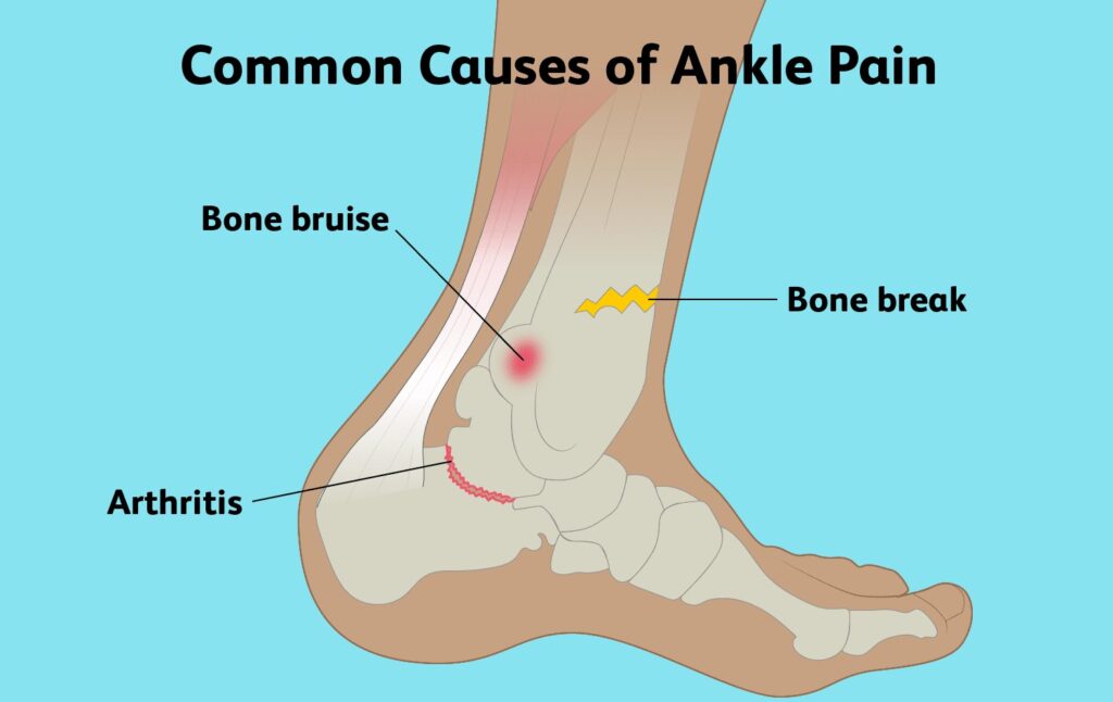 How to Deal with Pain Near the Ankle