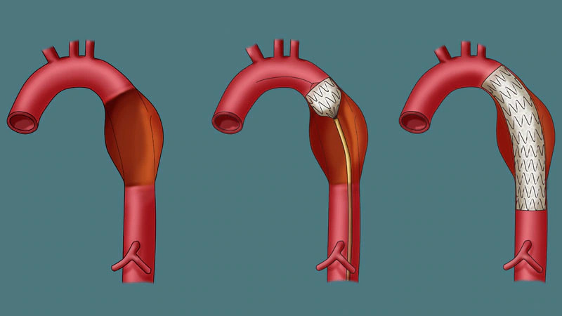 AORTIC DISSECTION SYMPTOMS
