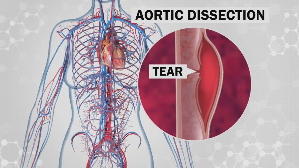 aortic dissection treatment