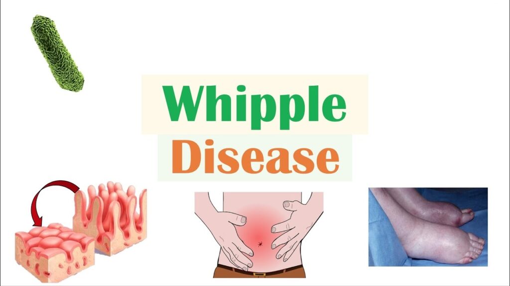 WHAT IS WHIPPLE'S DISEASE?