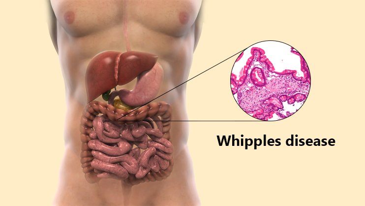 WHIPPLE'S DISEASE CAUSES