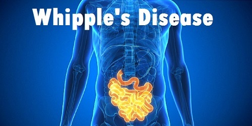 whipple's disease diagnosis