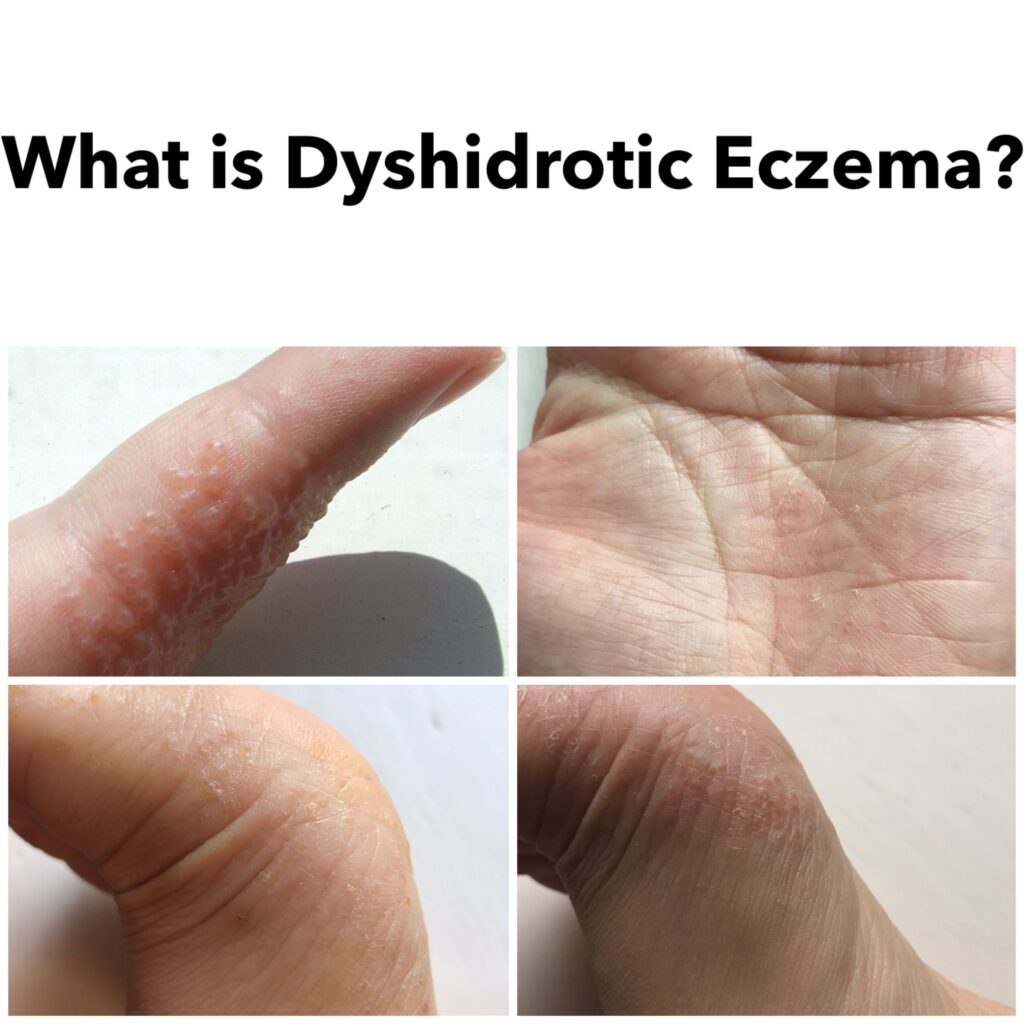What is Dyshidrosis Eczema?