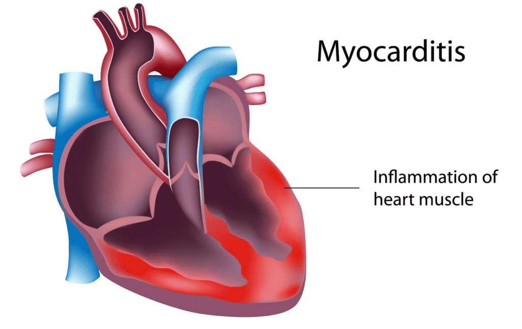 Myocarditis