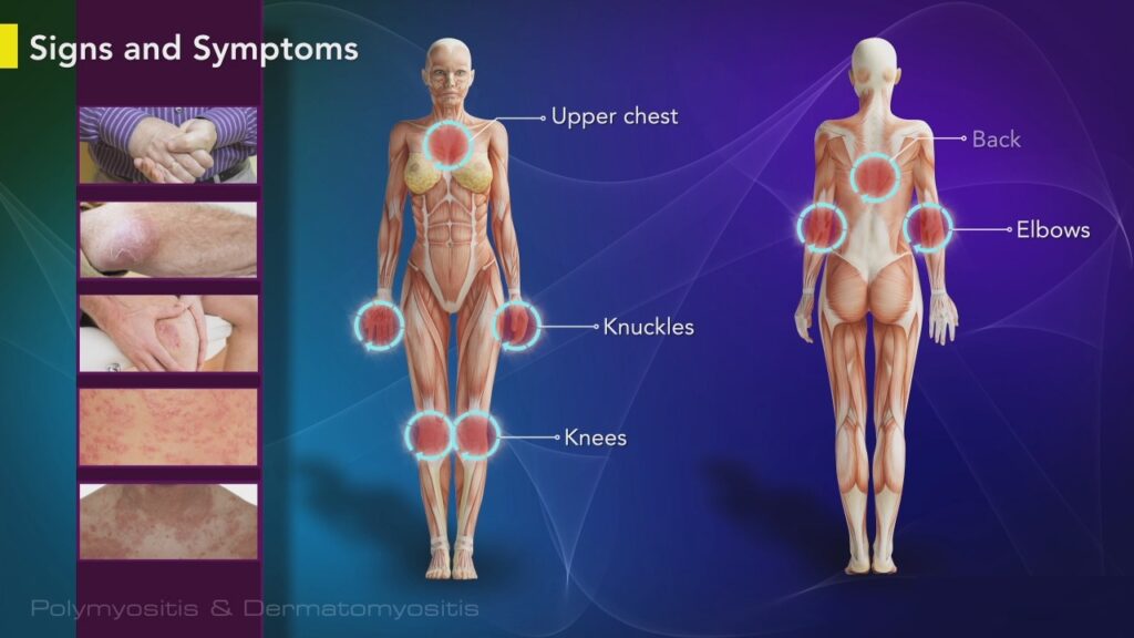 Polymyositis Symptoms