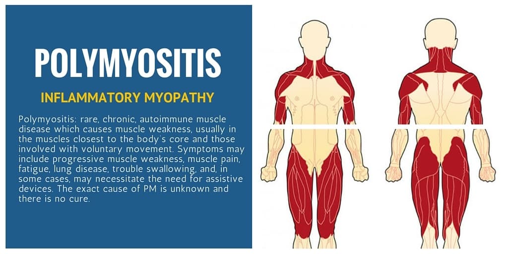 polymyositis-causes