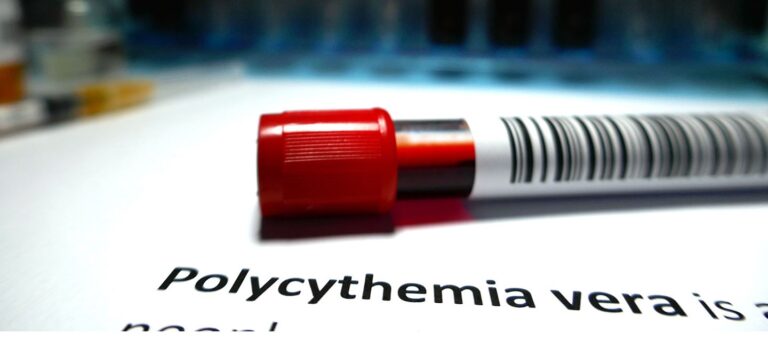 Polycythemia Vera Diagnosis