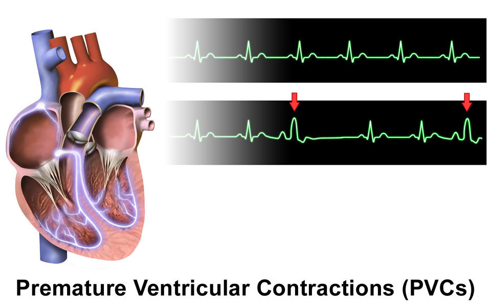 Symptoms Premature Ventricular Contractions