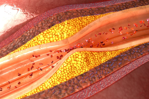 Premature Ventricular Contractions Treatment