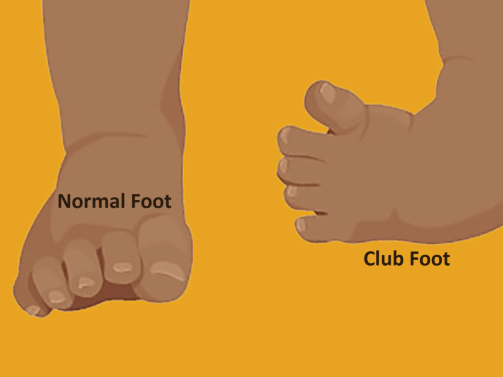 Symptoms of Clubfoot