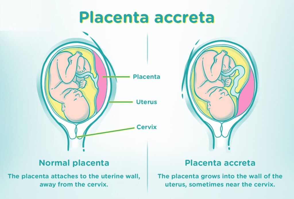 placenta accreta symptoms