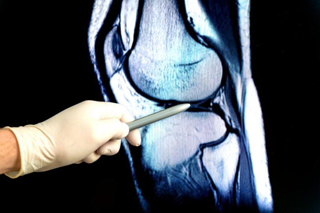 knee crepitus