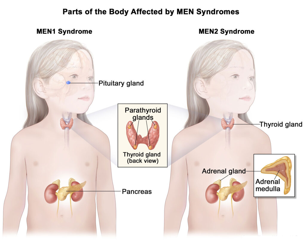 part of body affected by multiple endocrine neoplasia