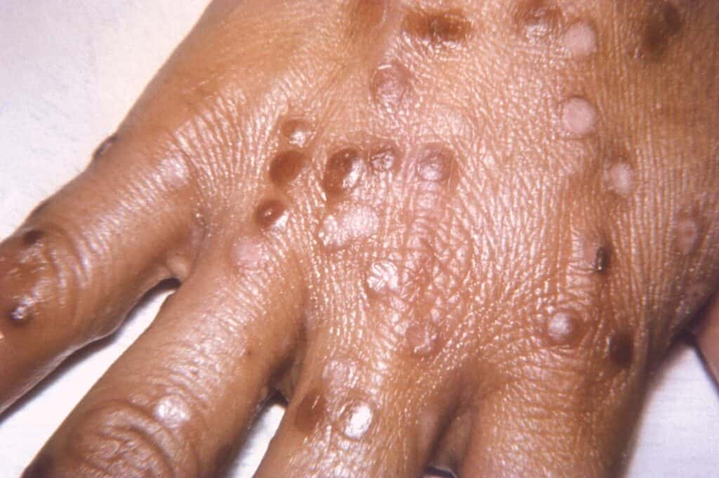 smallpox symptoms