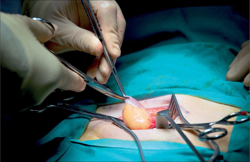 umbilical hernia surgery
