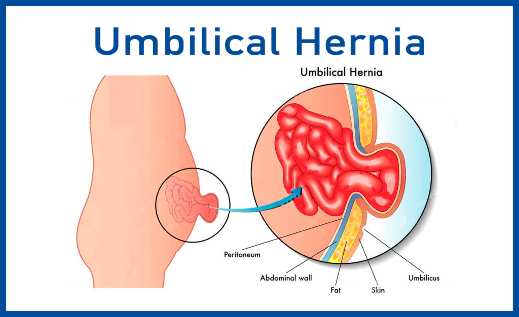 Umbilical Hernia