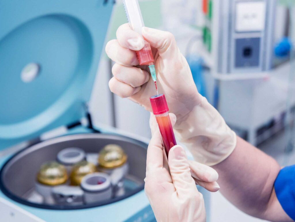 Platelet-Rich Plasma therapy