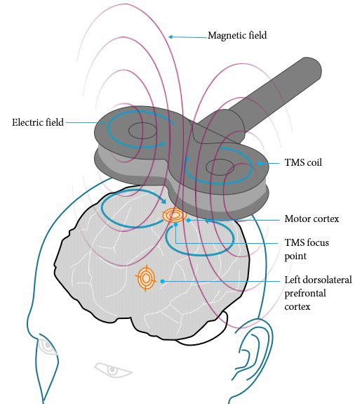 TMS treatment for Depression