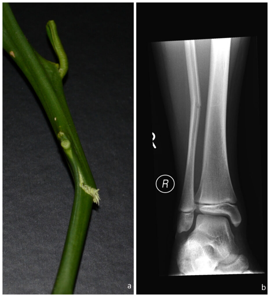 Greenstick fractures