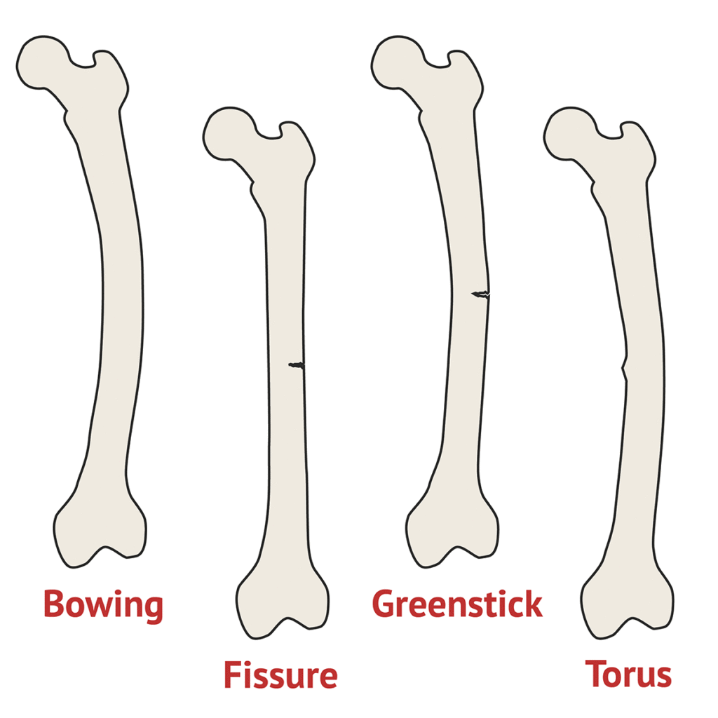 Greenstick fractures