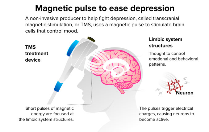 TRANSCRANIAL MAGNETIC STIMULATION TREATMENT DEVICE