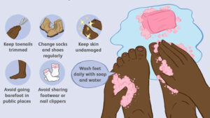 Toenail Fungus Infection: Causes, Symptoms, and Treatment