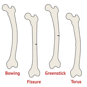 Greenstick fractures