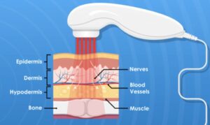 Cold Laser Therapy for Pain Management