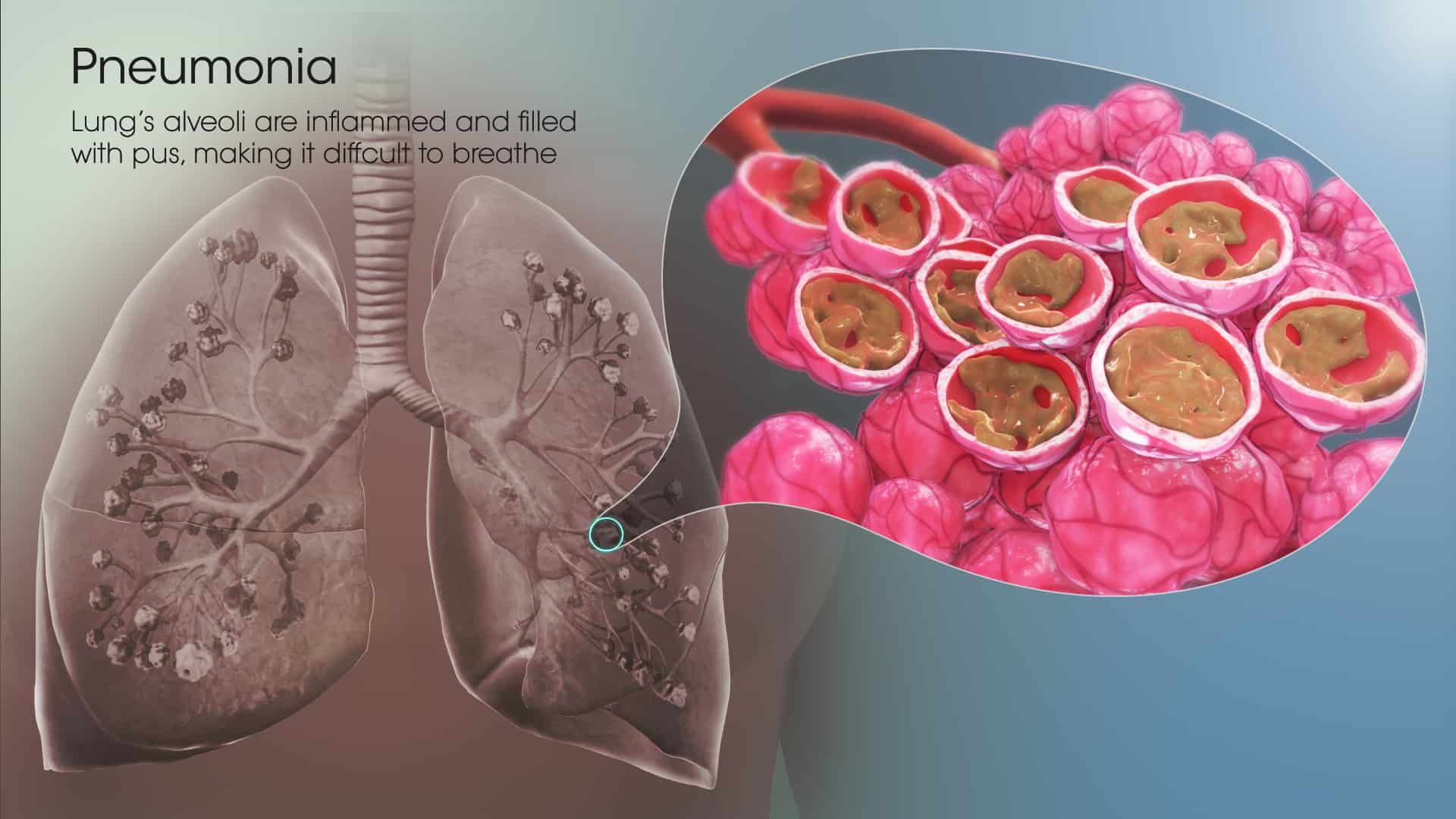 What is Pneumonia?