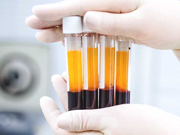  platelet-rich plasma treatment