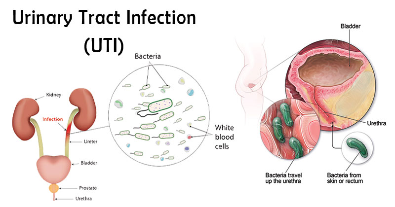 Urinary Tract Infection