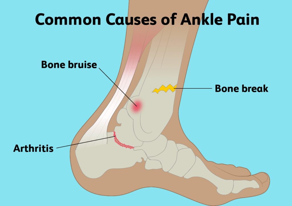 ankle pain causes
