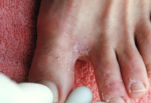 Athlete's Foot: Causes, Symptoms, and Treatment