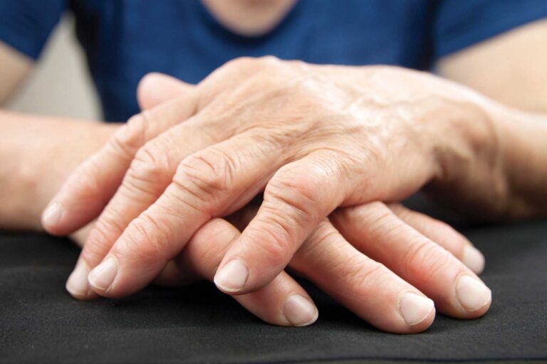 Hand arthritis O3 treatment