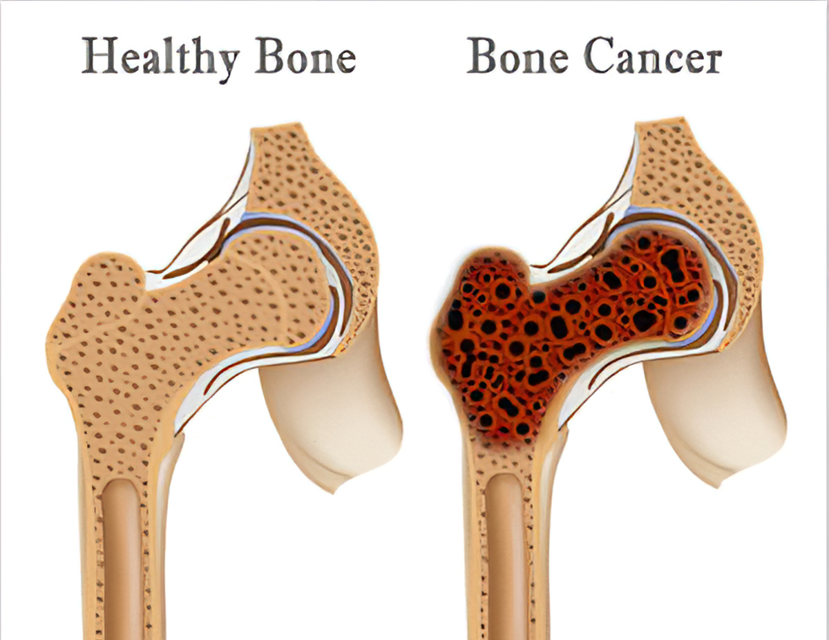 COMPARE WITHHEALTHYBONE AND BONE CANCER